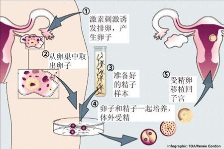 同性供卵代怀服务怎么收费
